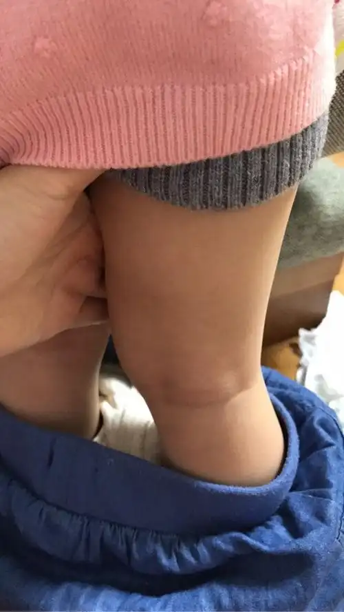 两岁女宝小腿不直是怎么回事呢急急急急
