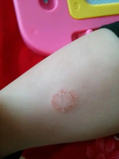 请懂得皮肤病的高手看看我女儿腿上长得是金钱癣吗?急急急,谢谢了!