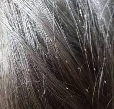 用白醋怎么去虱子2