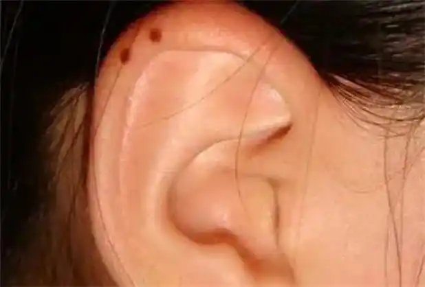 痣长在耳廓上怎么样(耳廓上有痣代表什么) - 业百科