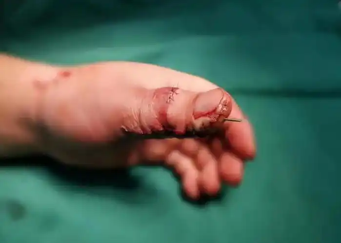 脚趾竟能变手指看郑州仁济专家如何移花接木再造拇指