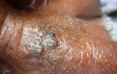 4大祛黑头秘诀让黑头远离你!