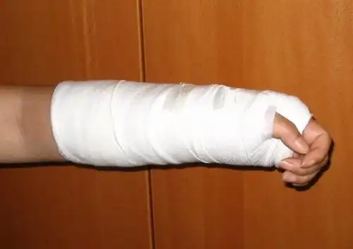 胳膊骨折吃什么食物好得快胳膊骨折后多久可以恢复到正常的强度