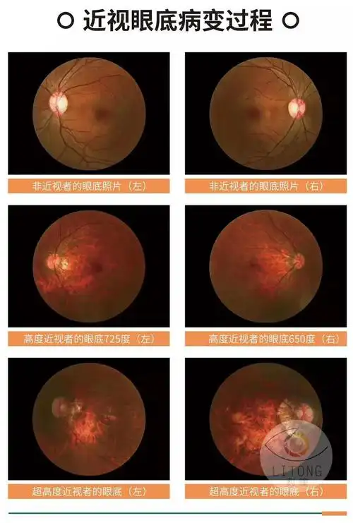 光学与视觉科学学院华柏恩教授,根据629名亚裔儿童的近视度数增长情况