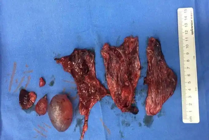 手术切下来的多处蜂窝样大疱病变手术同预期一样顺利结束,但术前的