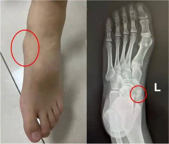仁济健康丨孩子经常说脚痛!不是装怪 是多长了个骨头_症状_治疗_局部