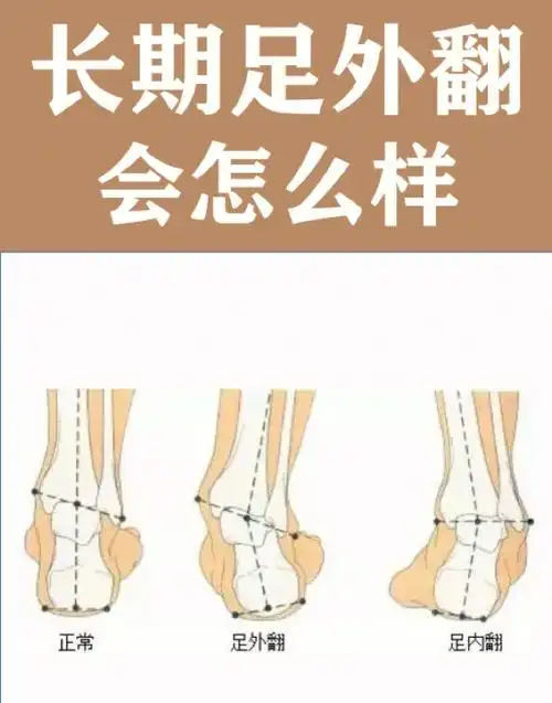 长期足外翻会怎么样