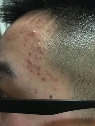 我这样的红肿发炎的痘痘该怎样治疗?