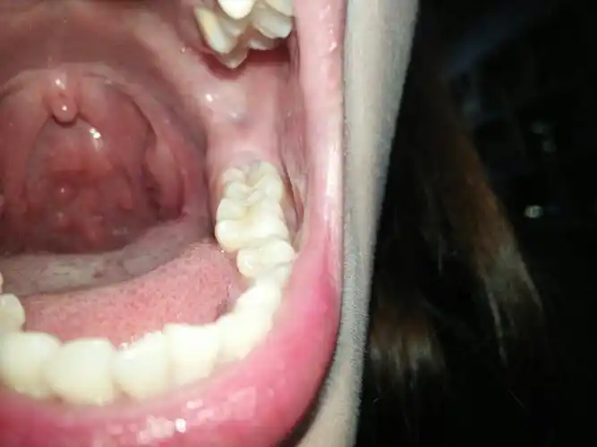 喉咙里起了好多小东西,只有早上醒那了觉得有点痛,总是感觉喉咙有痰