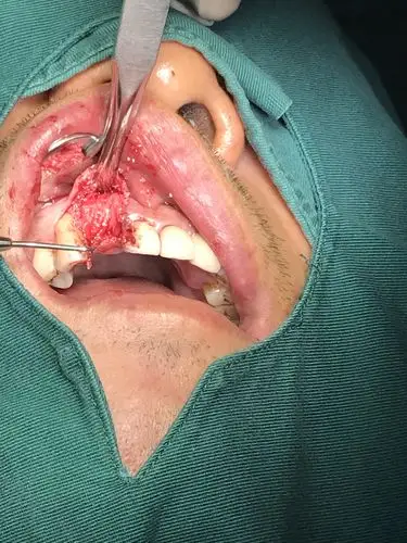 上颌前牙根尖囊肿摘除即刻种植一例 - 好大夫在线