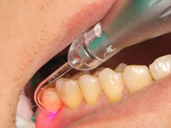 目前在牙周病科广泛应用,如辅助治疗重度牙周炎,牙周脓肿等