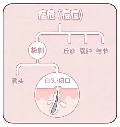 什么叫闭口粉刺和闭口的区别图片对比