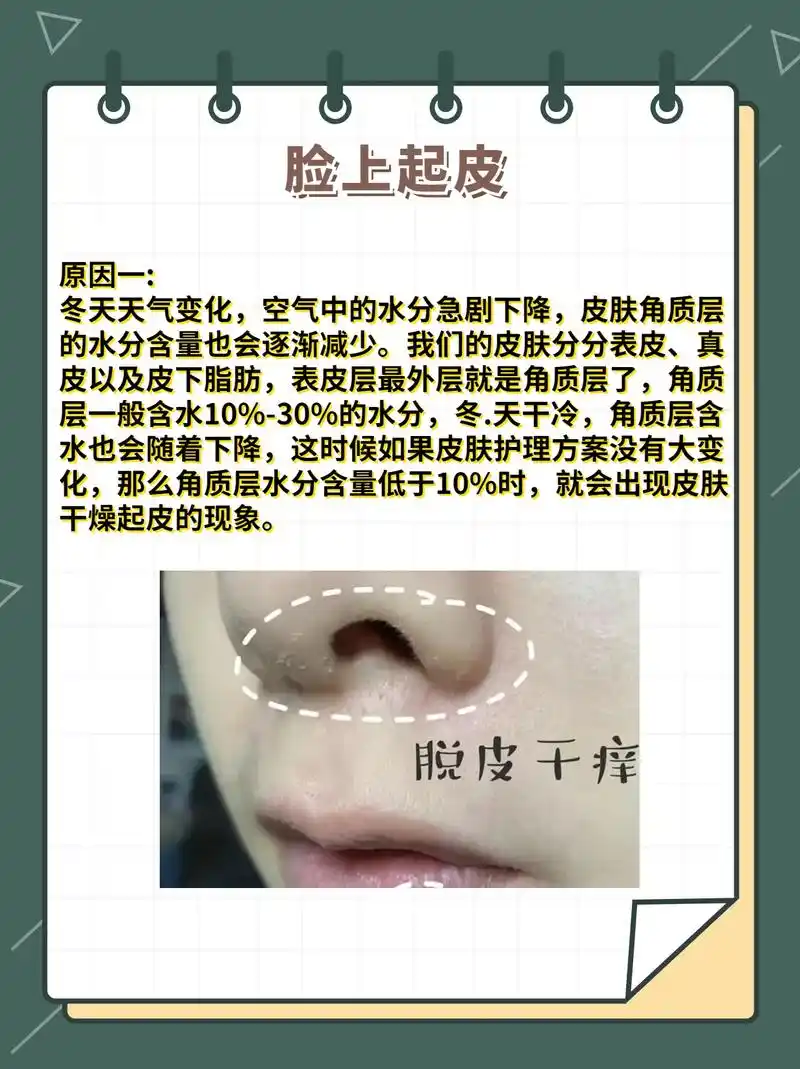 冬季天气干燥脸部起皮你有出现这样的情况吗.