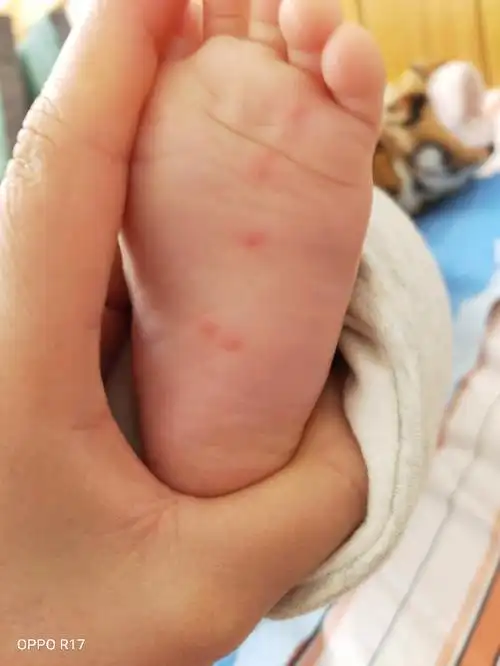 六个月宝宝这几天脚上长了些水痘