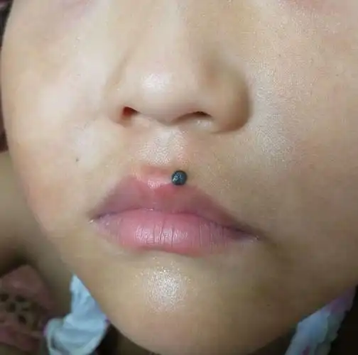 儿童色素痣手术