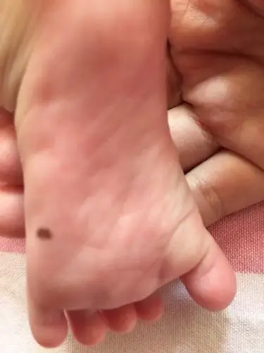 宝宝身上的黑痣会癌变?如何判断要不要尽早切掉?