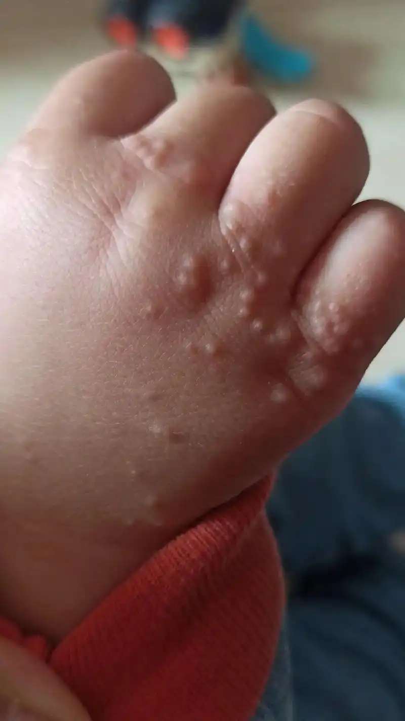 小孩手上长了好多小水泡一样的东西,身上也有,看了医生吃了药都 - 抖