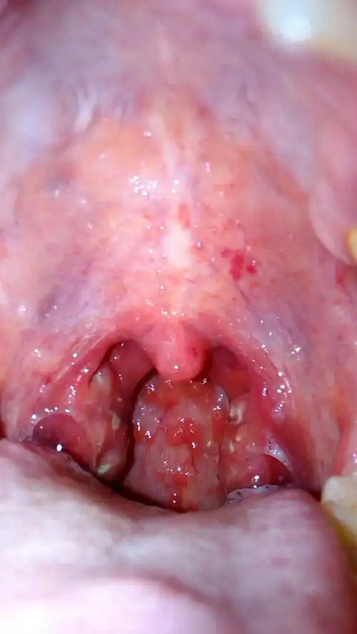 扁桃体发炎了没? 特疼,咽口水都痛,耳朵也有点疼,听力好像也不太好了.