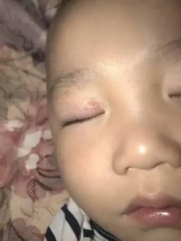 俩岁半的宝宝,上眼皮长得这个疙瘩有小半年时间了.