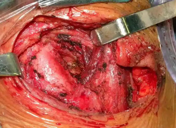 少年颈部反复红肿流脓十三年一刀除之——腮裂瘘一例