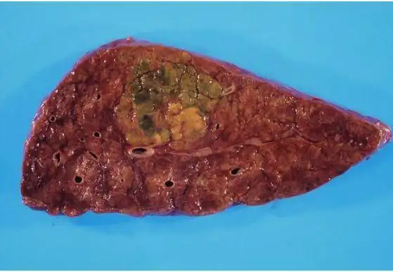 脂肪肝不能碰肥肉肝病科医生若想要肝脏好三种食物或可少碰