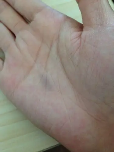 1689早上用劲的拍了几下手,结果右手掌心下面差不多