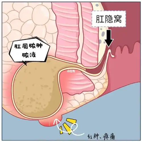 肛周脓肿与肛瘘有什么联系?