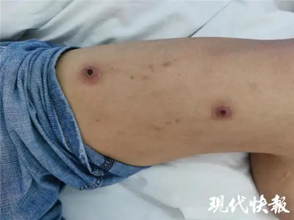 吴先生腿部有多处虫咬伤以及挠痕