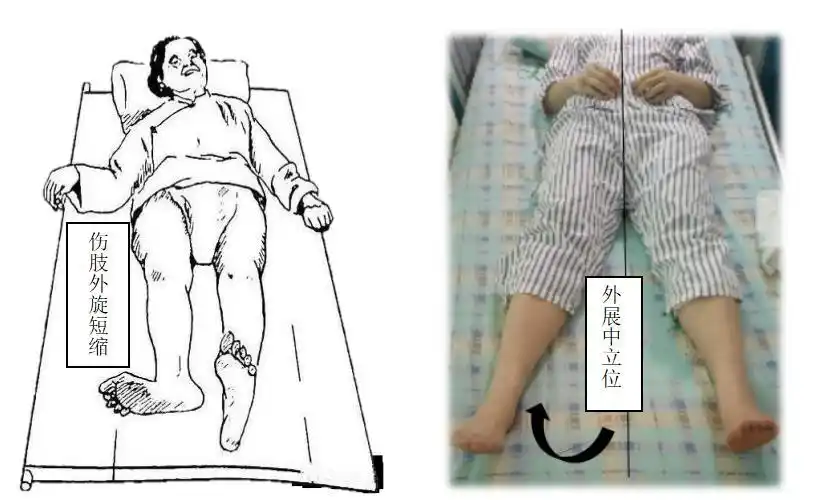 进一步加重骨折错位,引起难忍的疼痛,严重时可造成下肢短缩,走路跛行