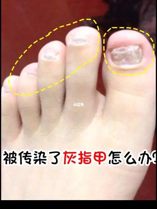 标题惊呆了灰指甲会传染你还不知道吗