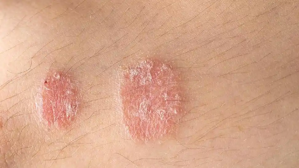 神经性皮炎的好发部位是哪里 神经系皮炎有哪些症状-神经性皮炎治疗