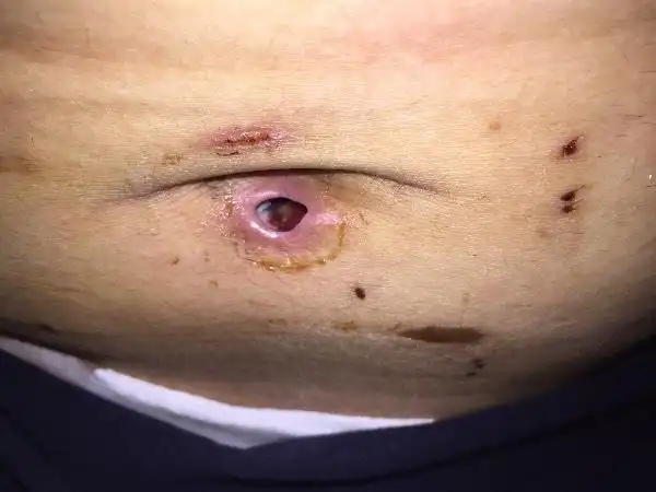 阑尾炎微创手术后的伤口,已经有12天了,这正常吗?这个洞洞怎么好的