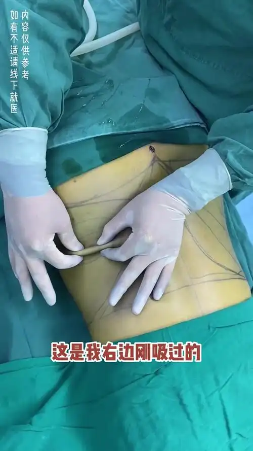 腰腹环吸 妈妈臀吸脂,术后小蛮腰你爱了吗?