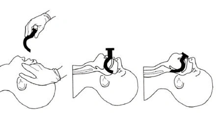 5,鼻咽通气道:长度:从鼻尖至外耳道口的距离.
