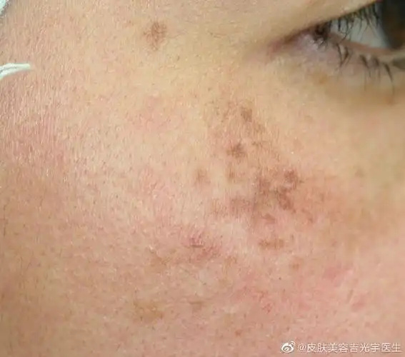 很多人做了光子嫩肤觉得不仅没什么作用,还容易变干,出现了色素沉着