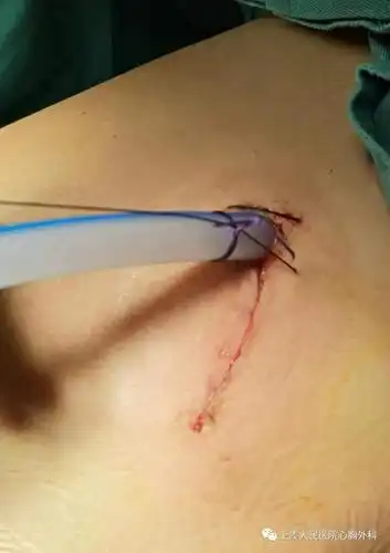 早期肺癌不要慌微创手术除病灶