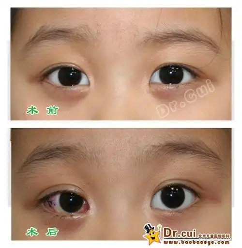 间歇性外斜视术前术后照片