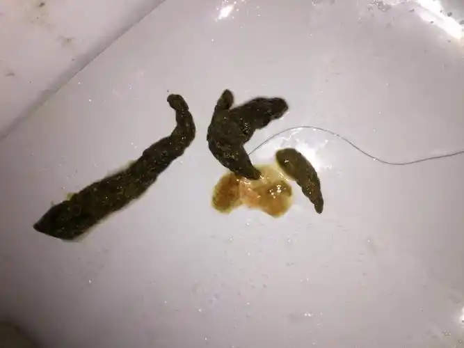 大便不正常的原因有哪些