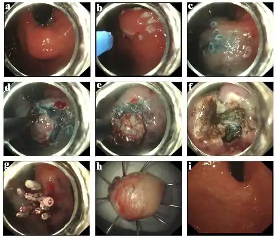 内镜下氩离子凝固术治疗胃肠道息肉的临床研究