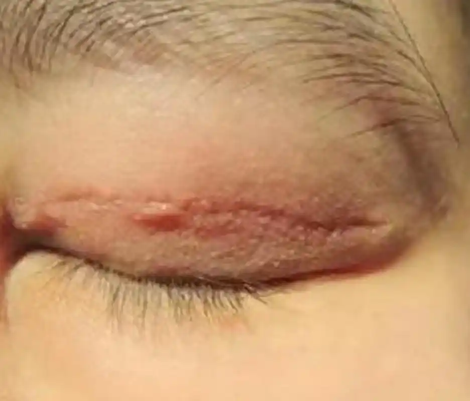 为什么做完双眼皮后,闭眼疤痕会很明显? 可能是这三个原因,注意了!