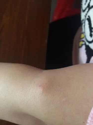 胳膊肘皮下长了个疙瘩,三个多月的样子了,开始没多大,现在越长越大,越