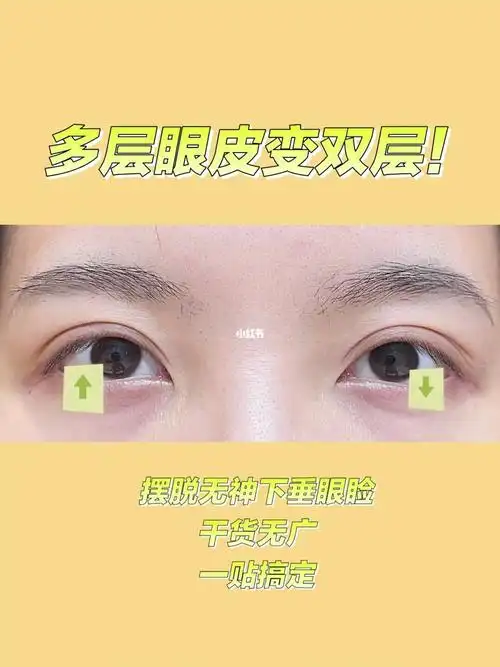 多层眼皮变双层炯炯有神大双眼皮我来了