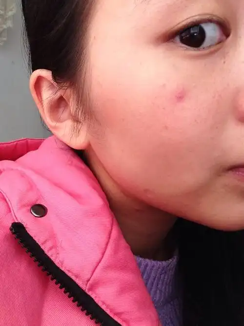出现了一个红点,直径约5毫米左右,没有变大和颜色加深的情况,不痛不痒