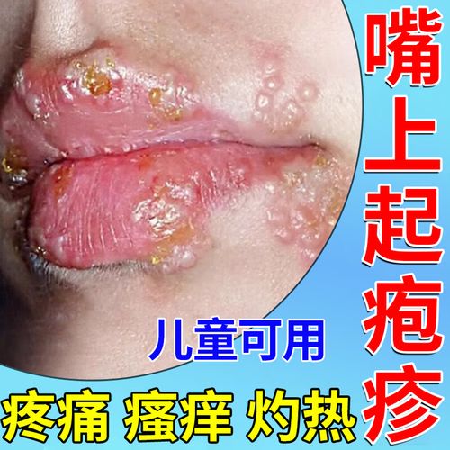 嘴唇疱疹特痒效药上火起泡嘴巴脓疮单纯疱疹引起嘴唇起疱疹瘙痒疼痛