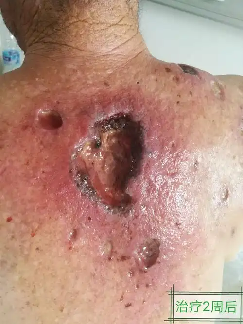 坏疽性脓皮病诊治1例