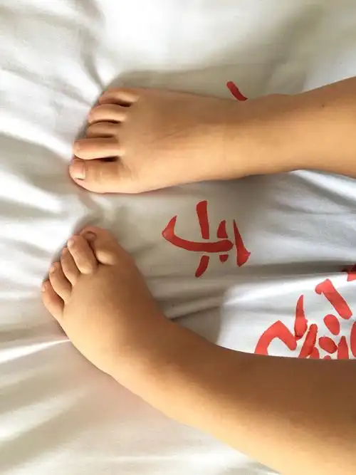 科普时间 先天性马蹄内翻足 - 好大夫在线