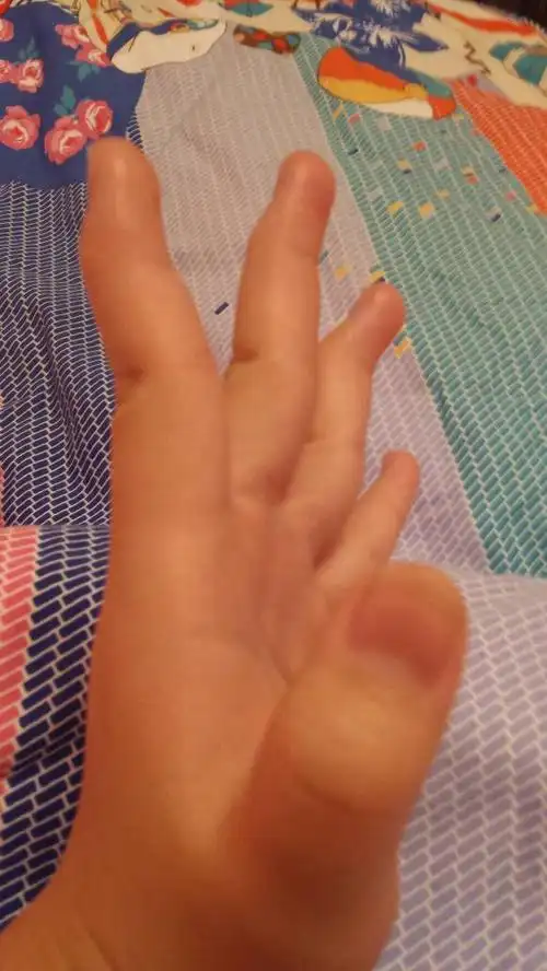 11岁手指是弯的,是什么原因啊,有没有人和我一样 怎么变直啊,同学都