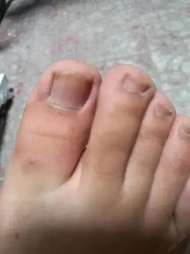 大母脚趾甲变灰