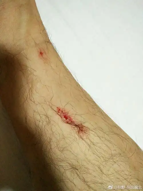 腿儿也擦破了皮儿!