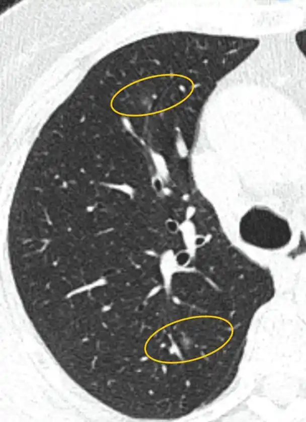 65岁双肺多发磨玻璃结节介于原位到微浸润腺癌之,别急,可以等等